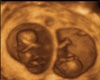 Kaliyah's 1st ultrasound