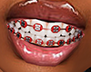 F| Colored Braces v3