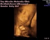MrsChulo's Ultrasound 