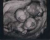 twin ultrasound sticker
