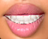 Porcelain Veneers