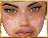vitiligo skin