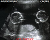 RED TWINS ULTRASOUND PIC