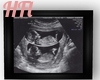 Twin 4 Months Ultrasound