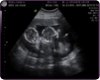 OUR TWIN ULTRASOUND