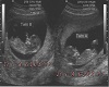 3 Month Twin Girls