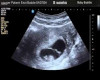 enviis ultrasound 8 wks