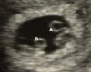 5 week twin sonogram