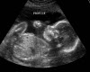 IM A GIRL ULTRASOUND