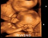 Twins Sonogram