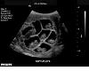 septuplets ultrasound sk
