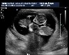 Kyr14ii4n3m Ultrasound