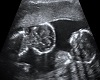 tori ultrasound